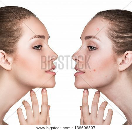 Comparison portrait of a woman with problematic skin before and after treatment