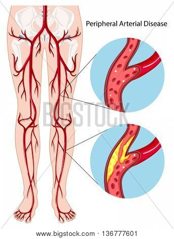 Peripheral arterial disease diagram illustration
