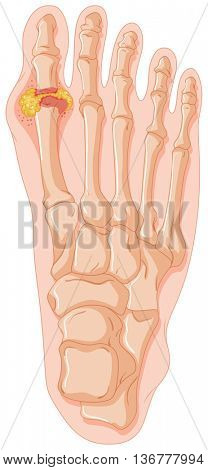 Diagram showing gout toe illustration