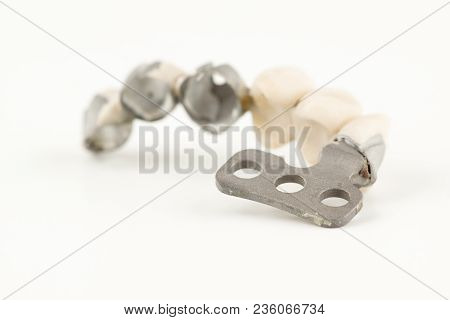 Damaged Dental Cermet Bridge Prosthesis On A Lamellar Implant