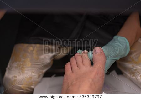Podiatrist Treating Toenail. Podology Treatment. Podology Of Applying Gel Polish To Remove Onycholys