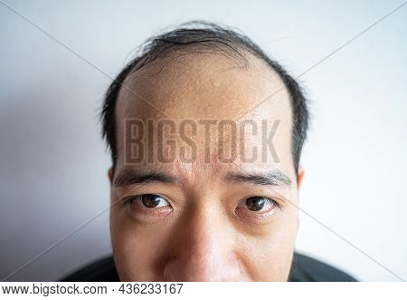 Closed Portrait Of Asian Man With Sweating On His Forehead Cause Of Hot Weather Or Etc. Sweat Is Act