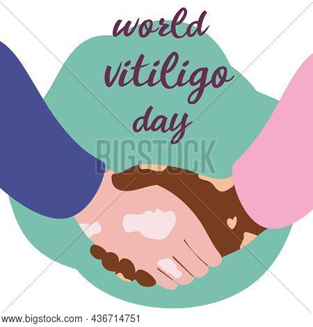 Two Hands With Vitiligo, Depigmentation Disease. Self Love, Body Positive. World Vitiligo Day