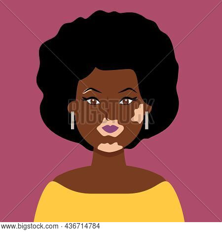 Portrait Of An African Woman With Vitiligo, Depigmentation Disease. Vector Illustration In Hand Draw