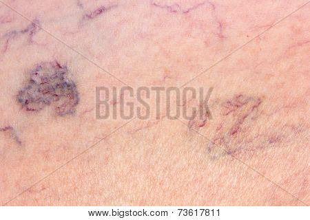 Leg Full Of Varicose Veins