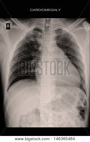 chest xray show heart cardiomegaly and lung
