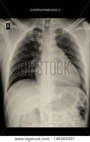 chest xray show heart cardiomegaly and lung