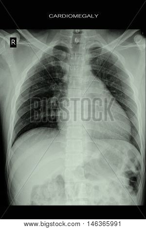 chest xray show heart and cardiomegaly and lung