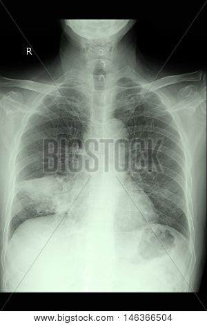 Chest xray PA upright show lung cancer and metastasis