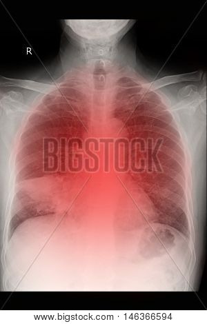 Chest xray PA upright show lung cancer and metastasis