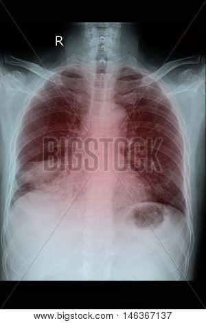 Chest xray PA upright show lung cancer and metastasis