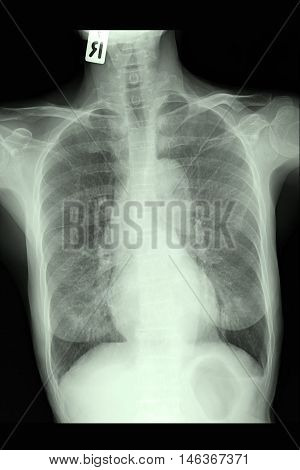 chest xray image show lung and infiltration