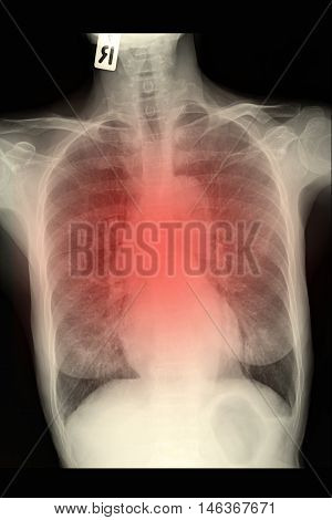 chest xray image show lung and infiltration