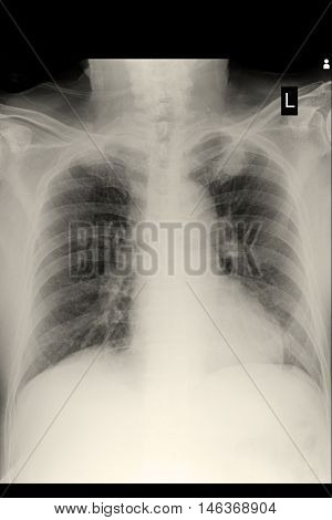xray image show chest xray and cardiomegaly
