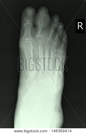 xray image show closed fracture index toe right foot