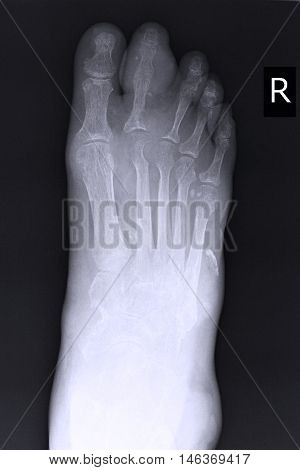 xray image show closed fracture index toe right foot