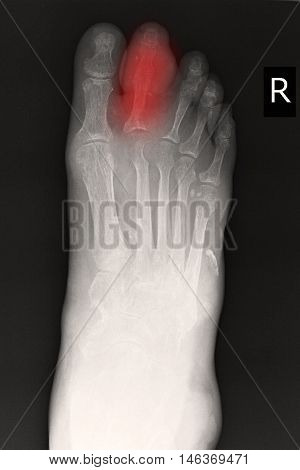 xray image show closed fracture index toe right foot
