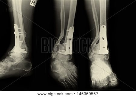 Ankle right joint : fracture ankle right joint