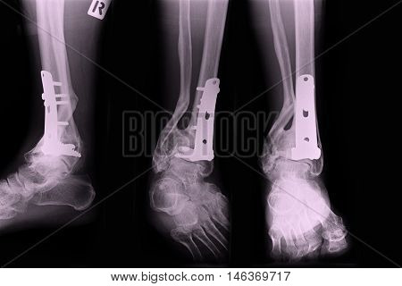 Ankle right joint : fracture ankle right joint