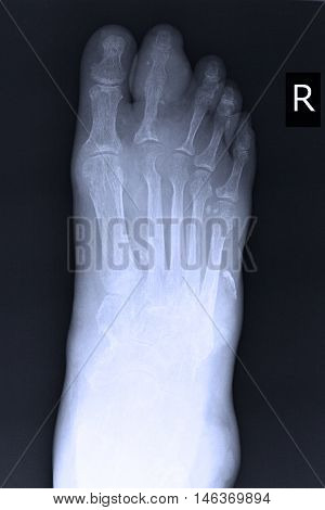 xray image show closed fracture index toe right foot