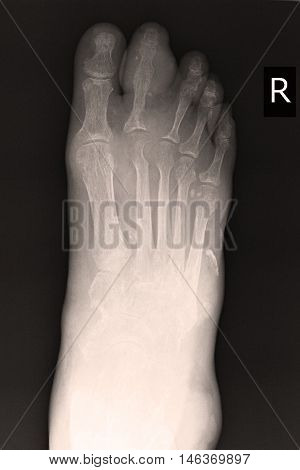 xray image show closed fracture index toe right foot