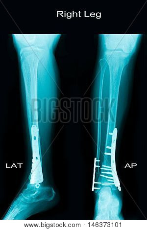 xray image show closed fracture fibula and tibia and post operation