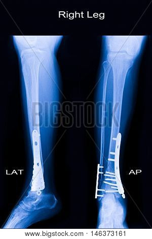 xray image show closed fracture fibula and tibia and post operation