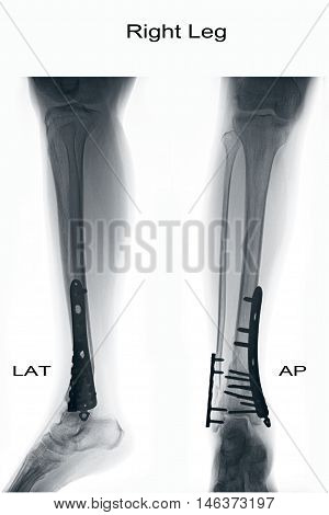 xray image show closed fracture fibula and tibia and post operation