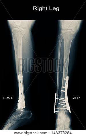 xray image show closed fracture fibula and tibia and post operation