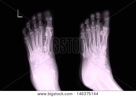 xray image show left foot AP,LAT  and fracture
