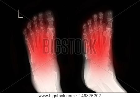xray image show left foot AP,LAT  and fracture