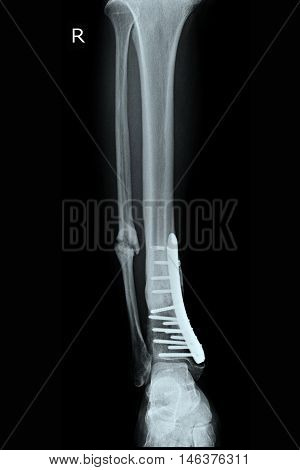 X-ray show fracture leg tibia and fibular and post operation