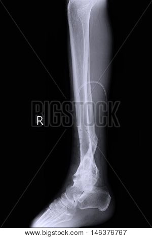 xray image show right foot and closed fracture tibia right