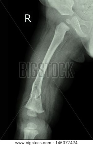 child xray image show fracture right femur