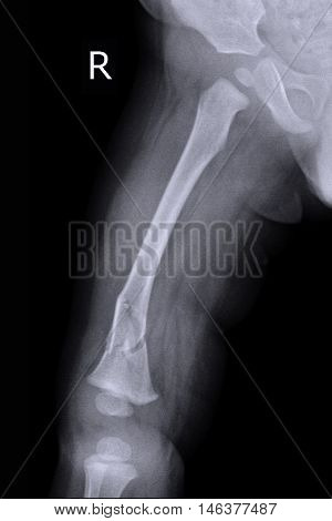 child xray image show fracture right femur