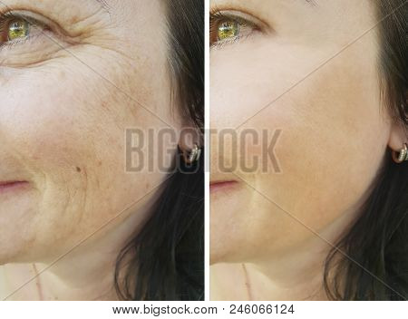 Face Wrinkles Before And After
 Therapy, Filler, Biorevitalization