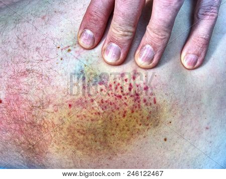 Bruised Wound Injury On Human Body. Patient Show Injured Body With Large Paintful Hematoma.
