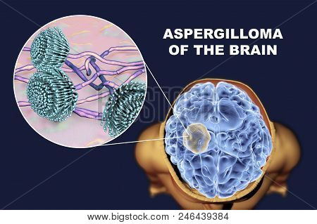 Aspergilloma Of The Brain And Close-up View Of Fungi Aspergillus, 3d Illustration. An Intracranial L