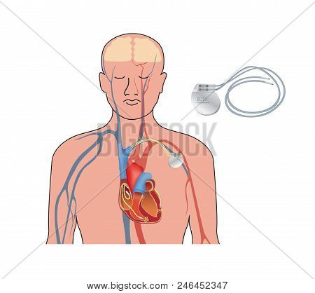 Heart Pacemaker. Human Heart Anatomy Cross Section With Working Implantable Cardioverter Defibrillat