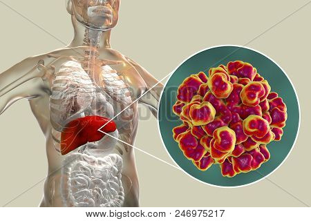 Hepatitis E Viral Infection, 3d Illustration. Non-enveloped Rna Viruses With Fecal-oral Transmission
