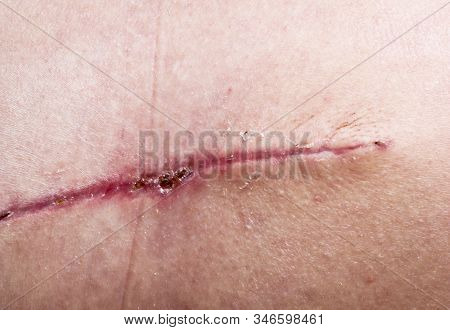 A Seam After Surgery On The Skin Of A Person’s Back. Surgical Transplantation Of A Muscle Flap From
