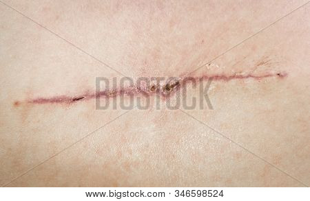 A Seam After Surgery On The Skin Of A Person’s Back. Surgical Transplantation Of A Muscle Flap From
