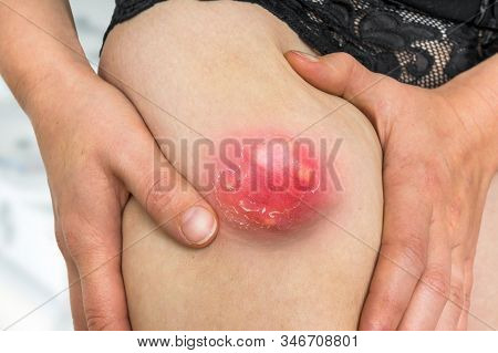 Detailed View Of Leg With Big Carbuncle Or Furuncle
