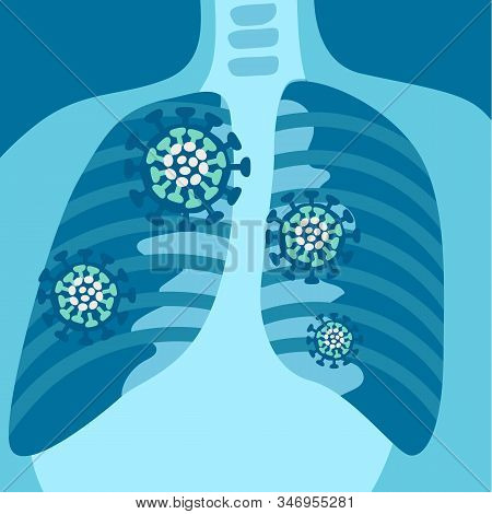 X-ray Of Respiratory System With Symptoms Of Pneumonia Or Coronavirus 2019-ncov