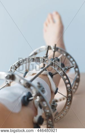 Leg In Ilizarovs External Fixator, Ilizarovs Apparatus