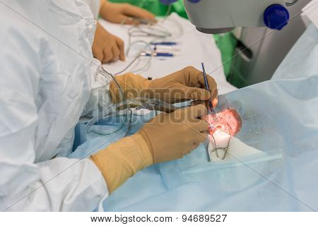 Ophthalmology cataract operation