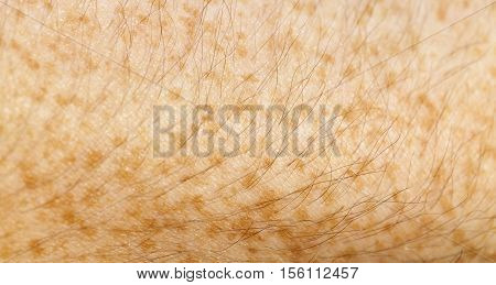 Photographed Close-up Part Of A Man's Hand, Covered With Orange Freckles