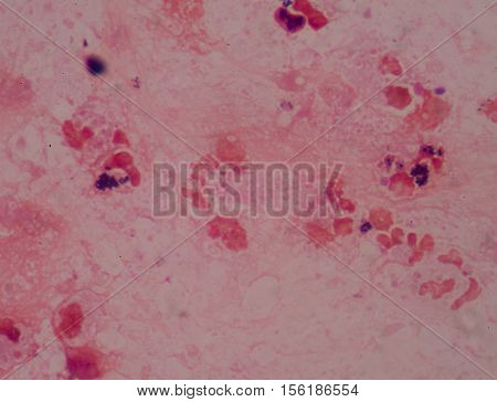 Gram Stain Showing Blue Cells Gram Positive In Single,in Pair,in Cluster Intracellular On Red White