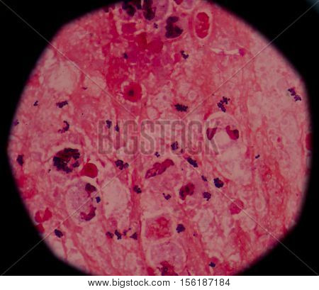 Gram Stain Showing Blue Cells Gram Positive In Single,in Pair,in Cluster Intracellular On Red White