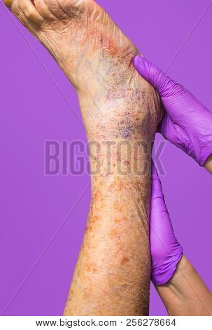 Close-up Of Skin With Varicose Veins On Senior Male Leg. Concept Of Dry Skin, Old Senior People, Var